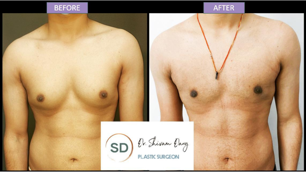 Gynecomastia surgery in Dehradun