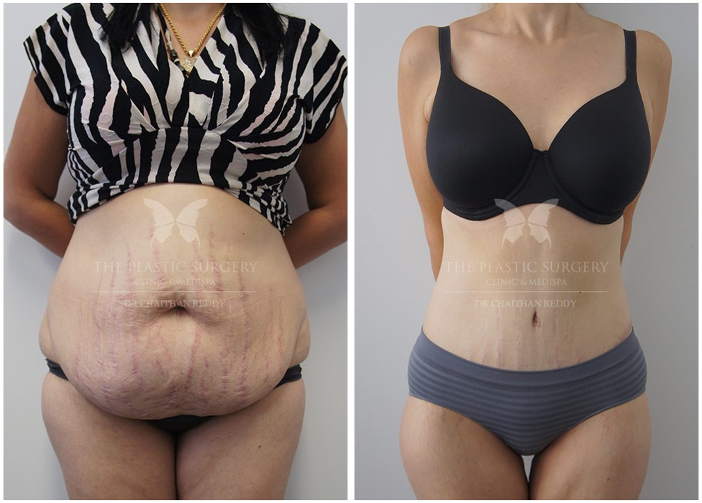 Tummy Tuck (Abdominoplasty): Achieving a Flatter, Toned Abdomen