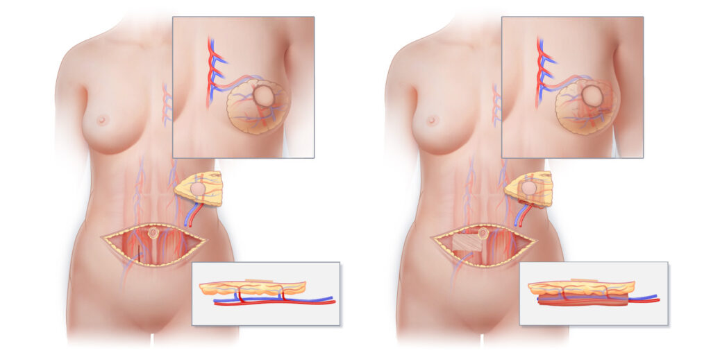 Breast Reconstruction (For Post-Mastectomy Patients)