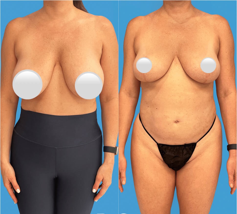 Breast Reduction (Reduction Mammoplasty): Everything You Need to Know