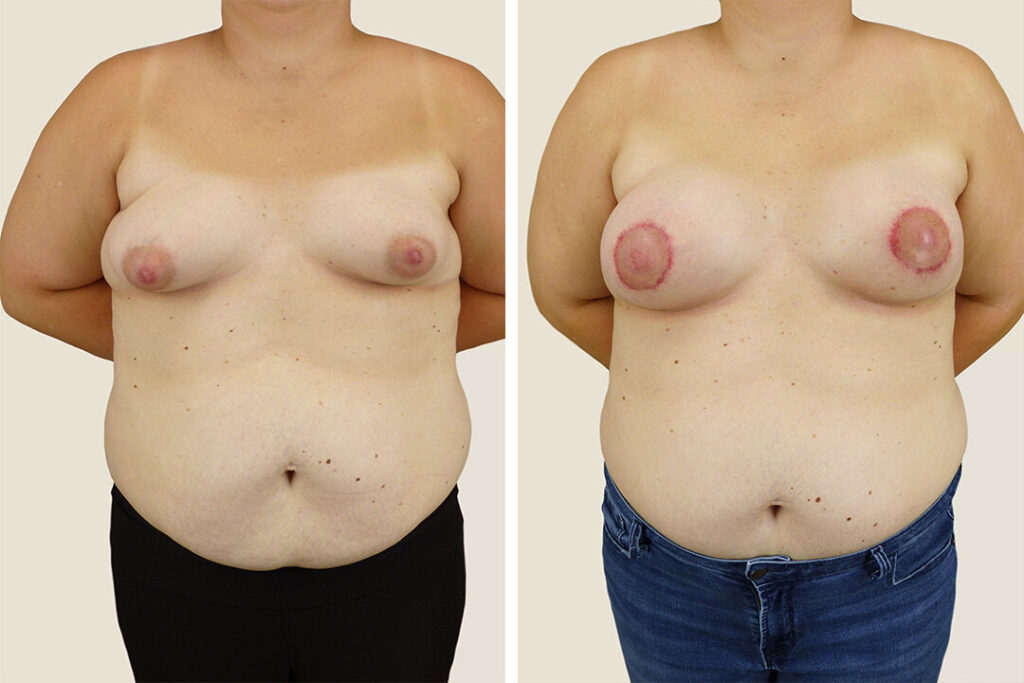 Breast Lift (Mastopexy): Everything You Need to Know