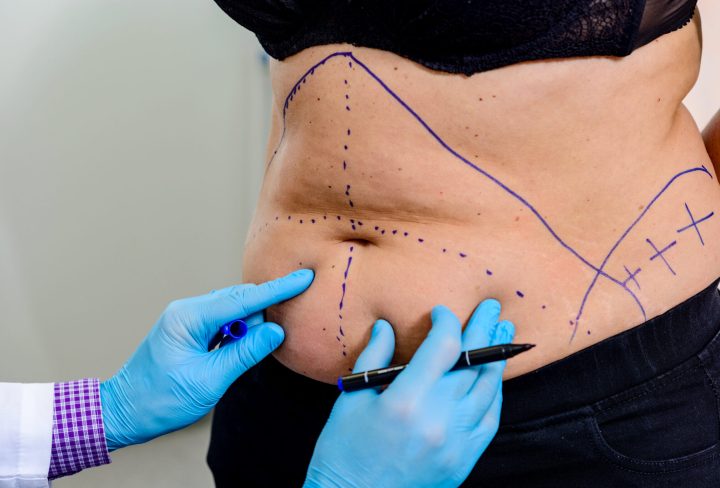 For clarity off  proses doctor drawing a dashed line on areas of the patient’s body. Preparing for an operation to remove  fat