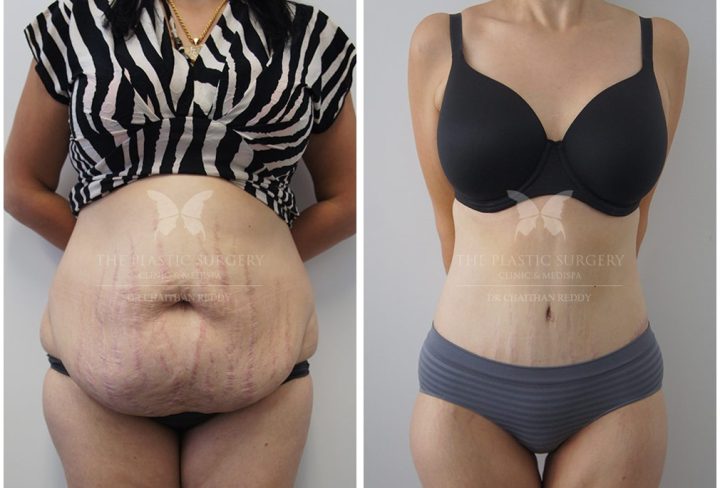 Tummy Tuck (Abdominoplasty): Achieving a Flatter, Toned Abdomen