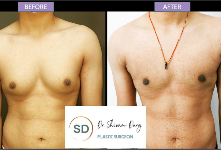 Gynecomastia surgery in Dehradun