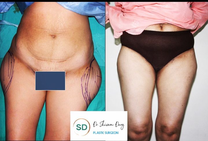 Liposuction