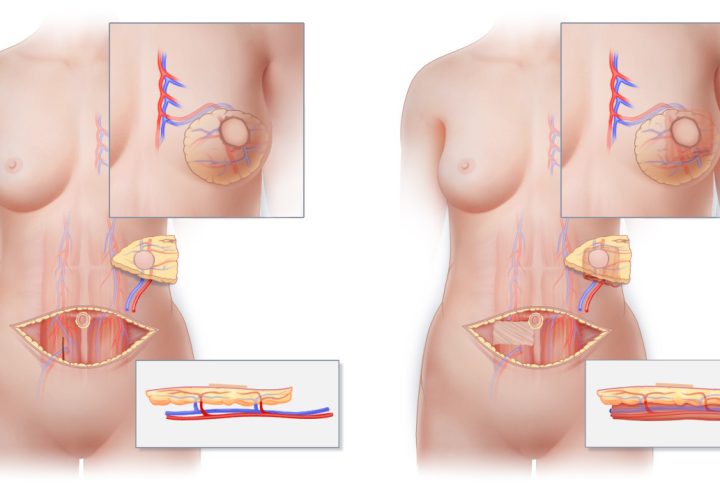 Breast Reconstruction (For Post-Mastectomy Patients)