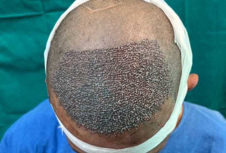 Everything You Need to Know About Hair Transplant by Dr. Shivam Dang