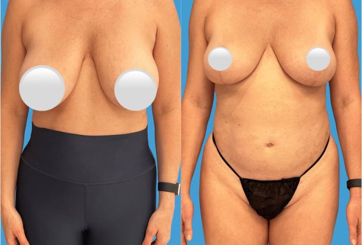 Breast Reduction (Reduction Mammoplasty): Everything You Need to Know