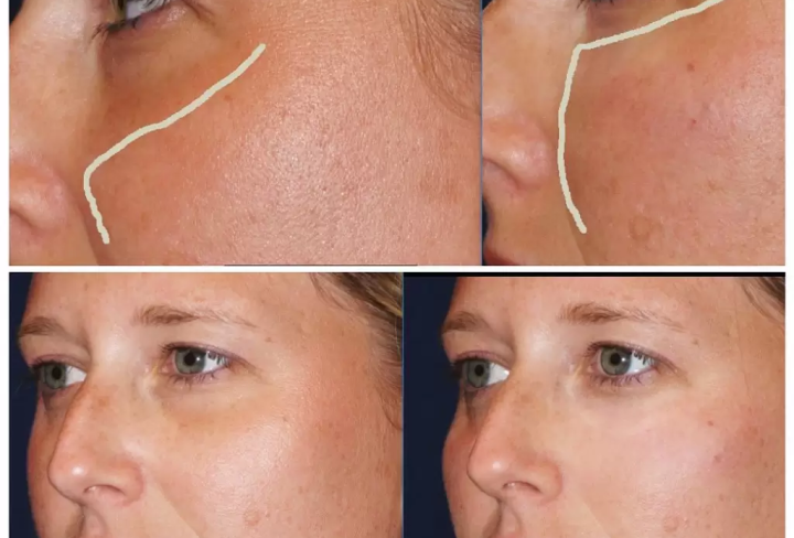 dermal-filler-under-eye-before-and-after-1024x1024