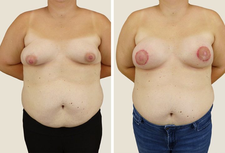 Breast Lift (Mastopexy): Everything You Need to Know