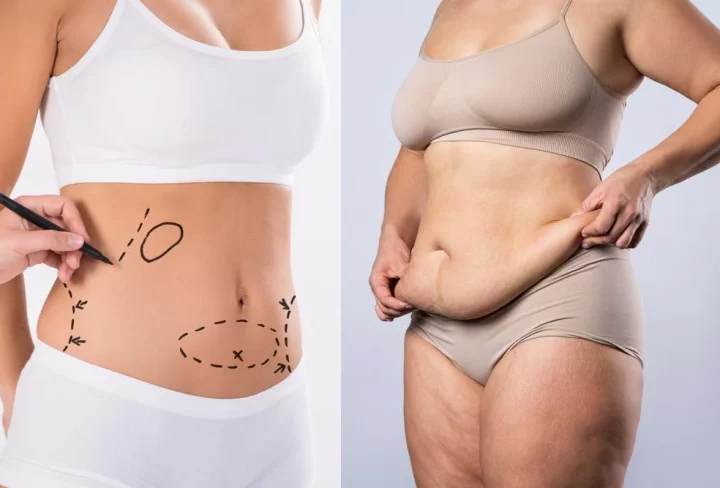 which-is-more-painful-liposuction-or-tummy-tuck